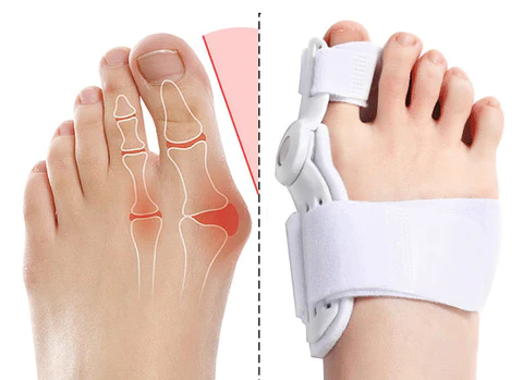 Bunion Corrector
